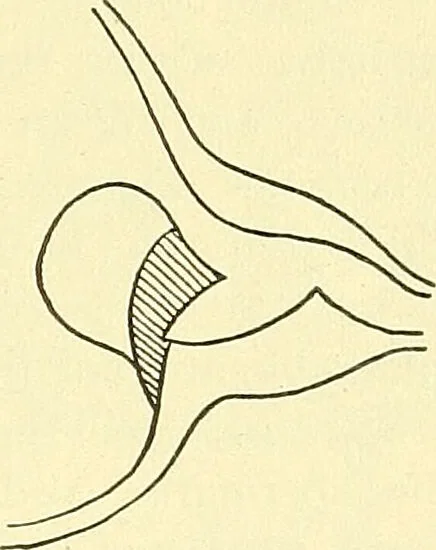 An illustration from Modern surgery, general and operative / by John Chalmers Da Costa., 1907, leaf 1219