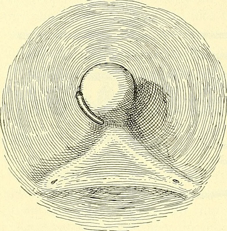An illustration from Modern surgery, general and operative / by John Chalmers Da Costa., 1907, leaf 1220