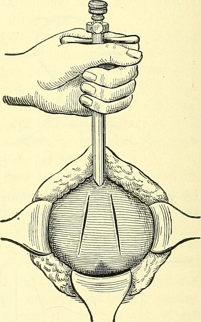 An illustration from Modern surgery, general and operative / by John Chalmers Da Costa., 1907, leaf 1220