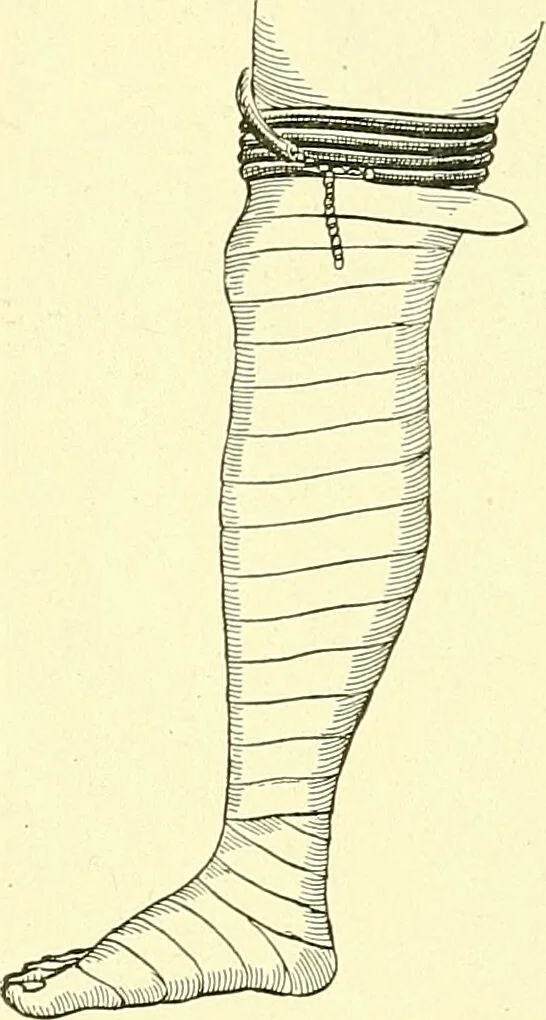An illustration from Modern surgery, general and operative / by John Chalmers Da Costa., 1907, leaf 1230