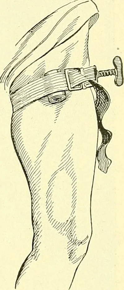 An illustration from Modern surgery, general and operative / by John Chalmers Da Costa., 1907, leaf 1230