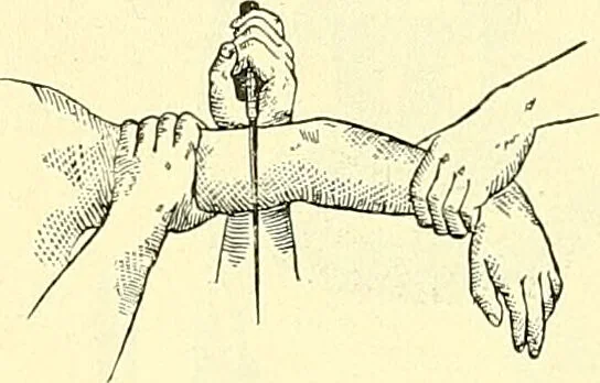 An illustration from Modern surgery, general and operative / by John Chalmers Da Costa., 1907, leaf 1232