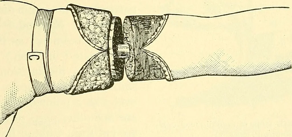 An illustration from Modern surgery, general and operative / by John Chalmers Da Costa., 1907, leaf 1233