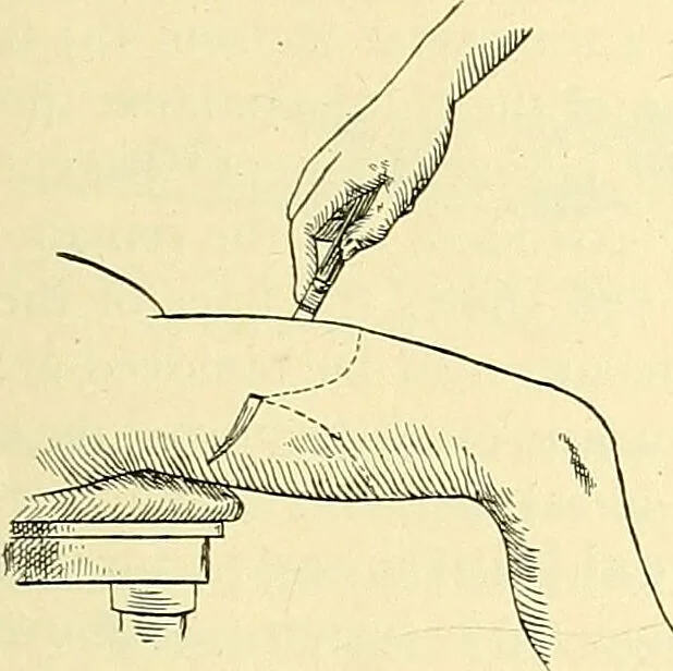 An illustration from Modern surgery, general and operative / by John Chalmers Da Costa., 1907, leaf 1235