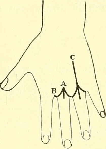 An illustration from Modern surgery, general and operative / by John Chalmers Da Costa., 1907, leaf 1236