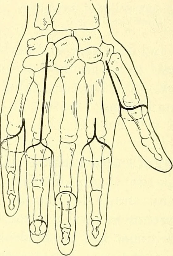 An illustration from Modern surgery, general and operative / by John Chalmers Da Costa., 1907, leaf 1236