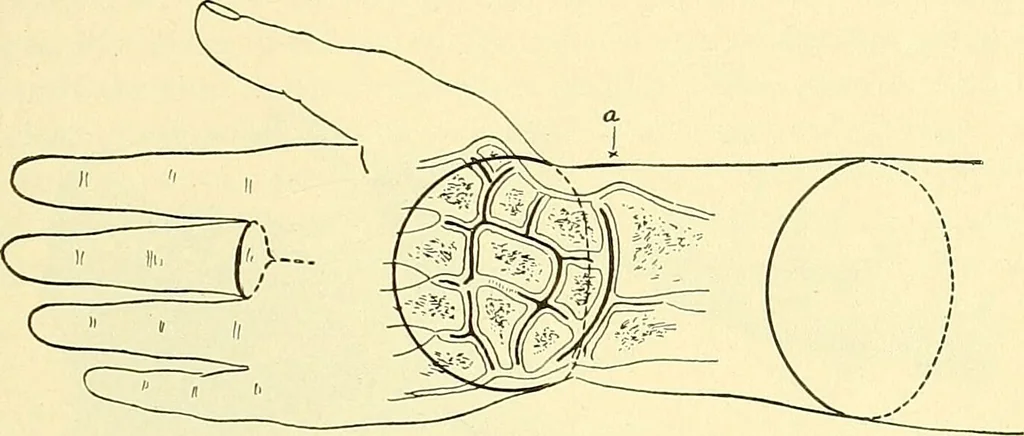 An illustration from Modern surgery, general and operative / by John Chalmers Da Costa., 1907, leaf 1237