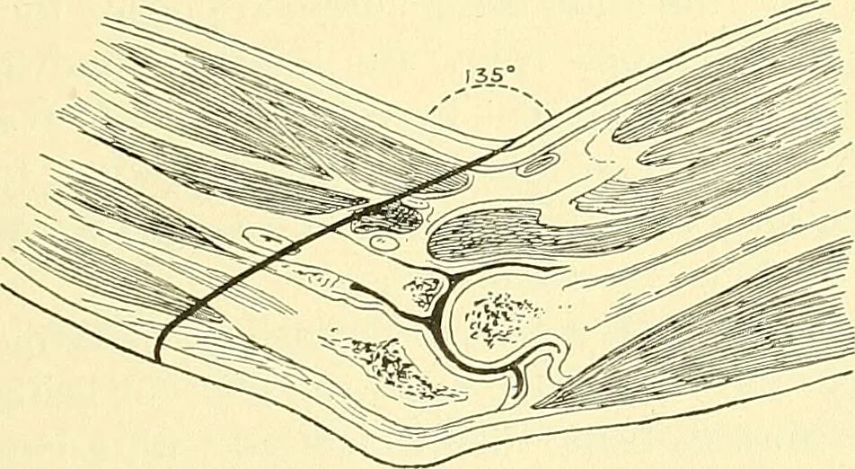 An illustration from Modern surgery, general and operative / by John Chalmers Da Costa., 1907, leaf 1237