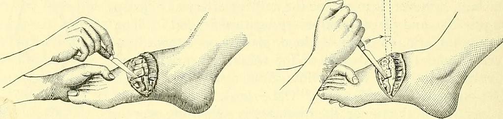 An illustration from Modern surgery, general and operative / by John Chalmers Da Costa., 1907, leaf 1242