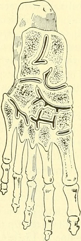 An illustration from Modern surgery, general and operative / by John Chalmers Da Costa., 1907, leaf 1242
