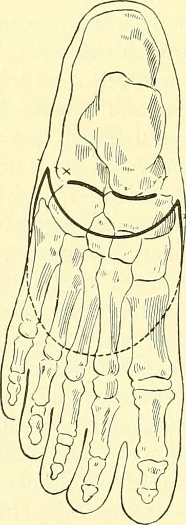 An illustration from Modern surgery, general and operative / by John Chalmers Da Costa., 1907, leaf 1242