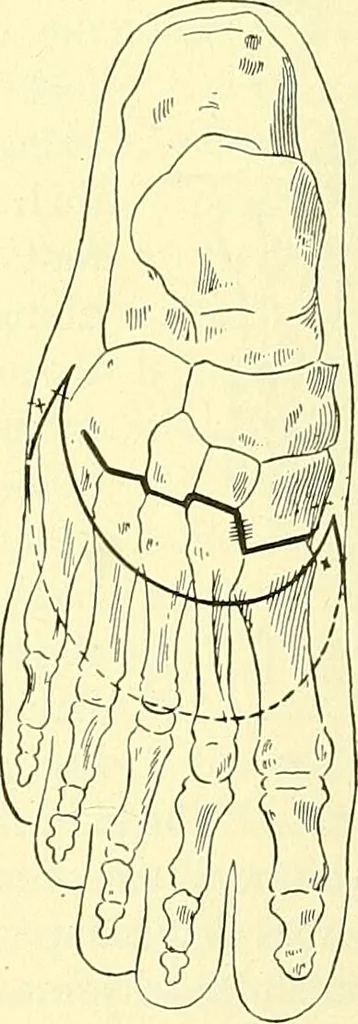 An illustration from Modern surgery, general and operative / by John Chalmers Da Costa., 1907, leaf 1242