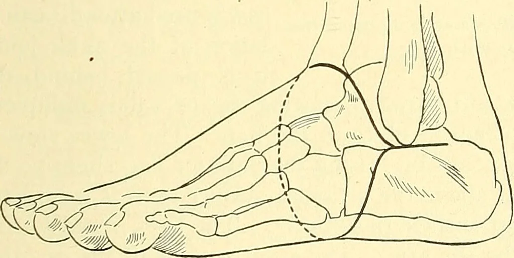 An illustration from Modern surgery, general and operative / by John Chalmers Da Costa., 1907, leaf 1243