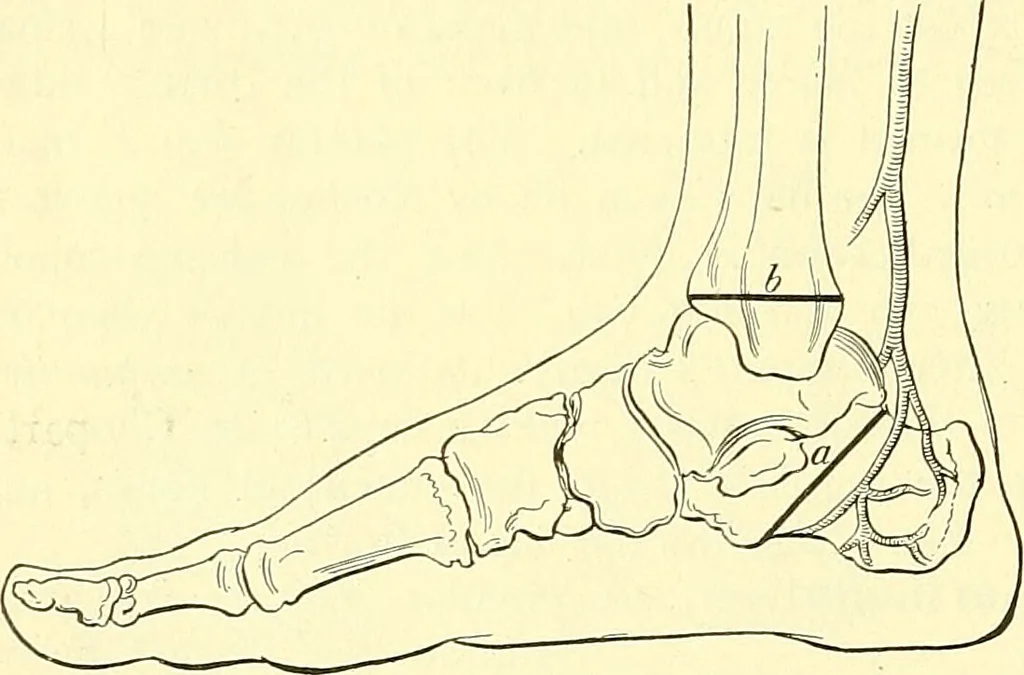 An illustration from Modern surgery, general and operative / by John Chalmers Da Costa., 1907, leaf 1244