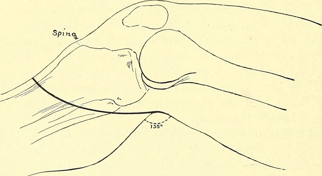An illustration from Modern surgery, general and operative / by John Chalmers Da Costa., 1907, leaf 1246