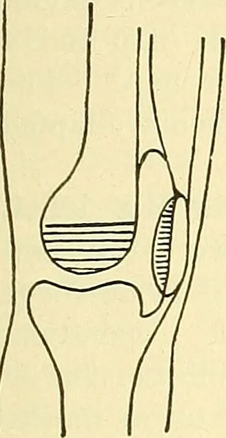 An illustration from Modern surgery, general and operative / by John Chalmers Da Costa., 1907, leaf 1247