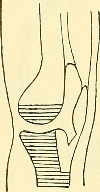 An illustration from Modern surgery, general and operative / by John Chalmers Da Costa., 1907, leaf 1247