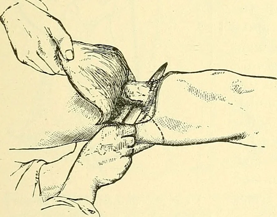 An illustration from Modern surgery, general and operative / by John Chalmers Da Costa., 1907, leaf 1247