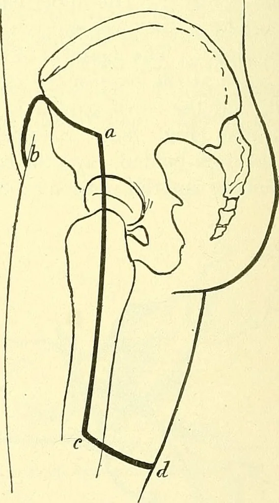 An illustration from Modern surgery, general and operative / by John Chalmers Da Costa., 1907, leaf 1248