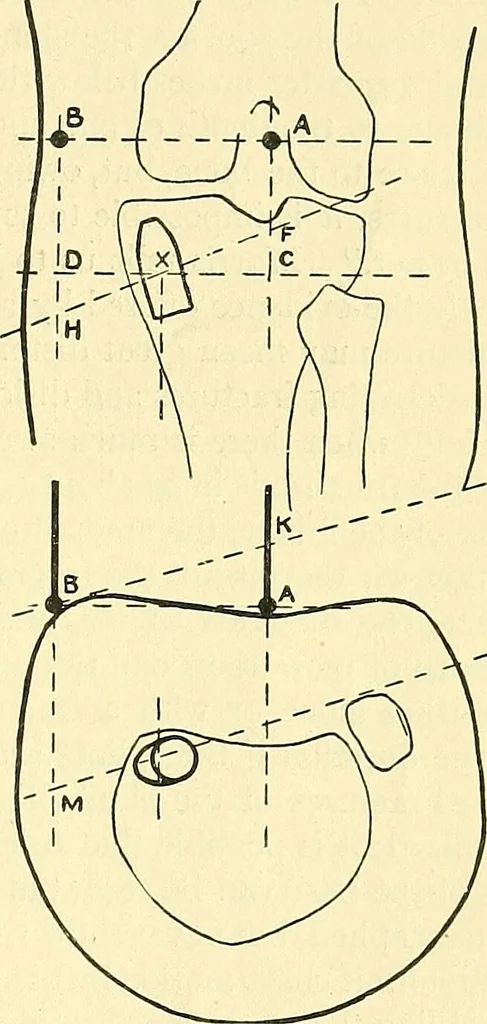 An illustration from Modern surgery, general and operative / by John Chalmers Da Costa., 1907, leaf 1277