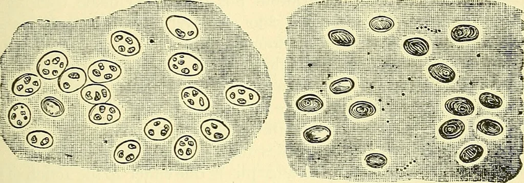 An illustration from Modern surgery, general and operative / by John Chalmers Da Costa., 1907, leaf 135