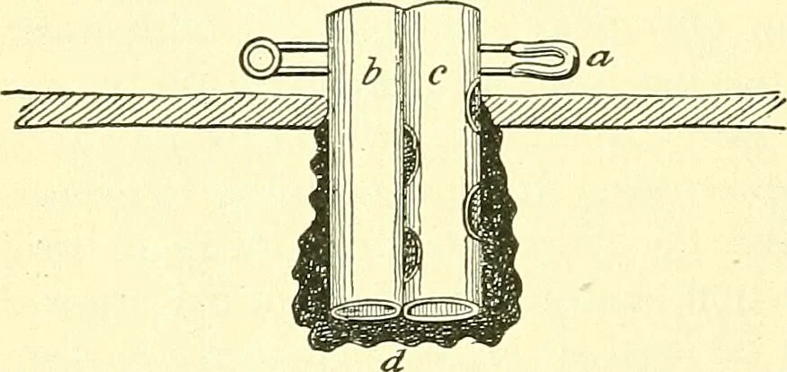An illustration from Modern surgery, general and operative / by John Chalmers Da Costa., 1907, leaf 150