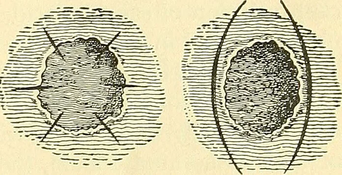 An illustration from Modern surgery, general and operative / by John Chalmers Da Costa., 1907, leaf 165