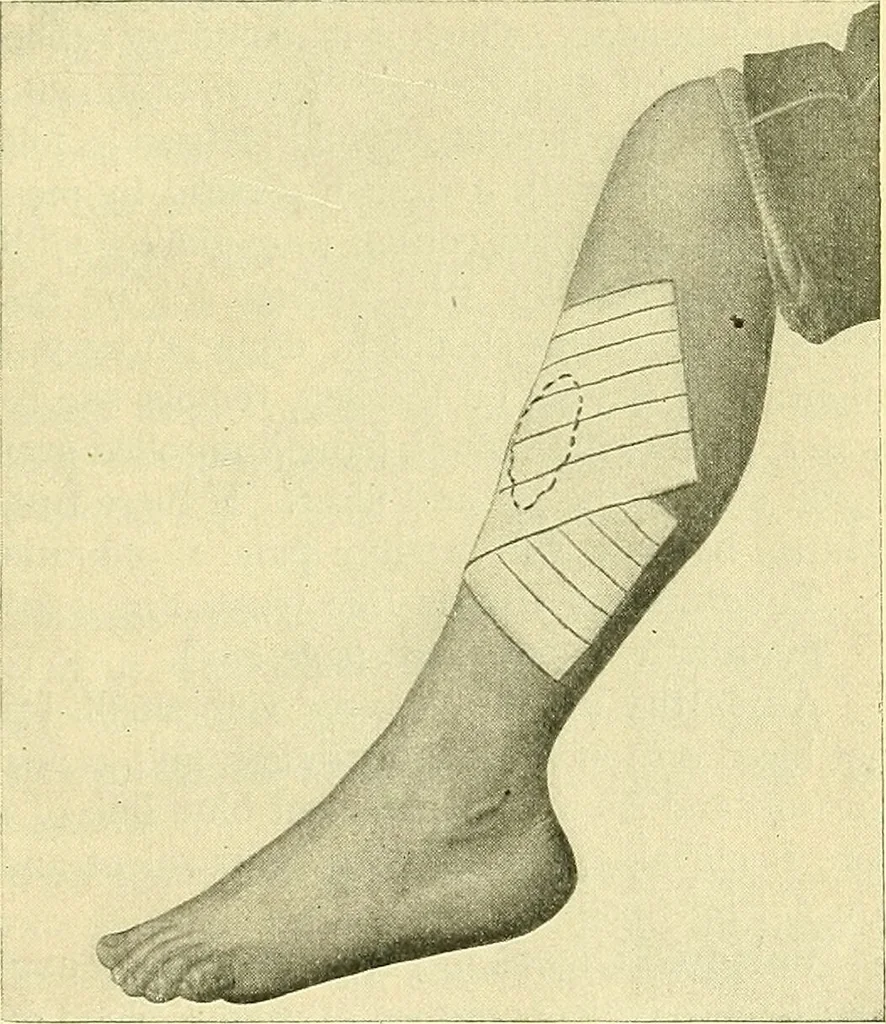 An illustration from Modern surgery, general and operative / by John Chalmers Da Costa., 1907, leaf 167