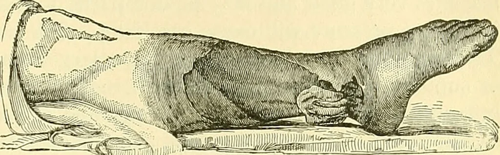 An illustration from Modern surgery, general and operative / by John Chalmers Da Costa., 1907, leaf 179