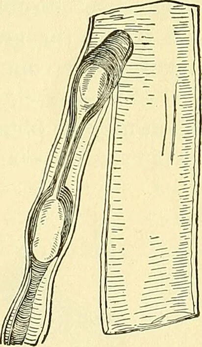 An illustration from Modern surgery, general and operative / by John Chalmers Da Costa., 1907, leaf 191