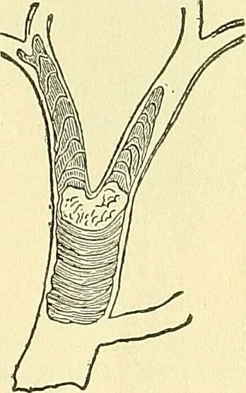 An illustration from Modern surgery, general and operative / by John Chalmers Da Costa., 1907, leaf 195