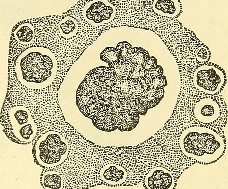 An illustration from Modern surgery, general and operative / by John Chalmers Da Costa., 1907, leaf 25