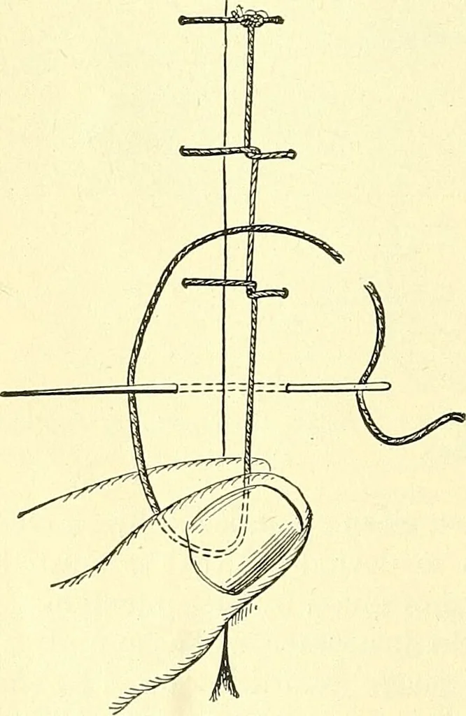 An illustration from Modern surgery, general and operative / by John Chalmers Da Costa., 1907, leaf 254