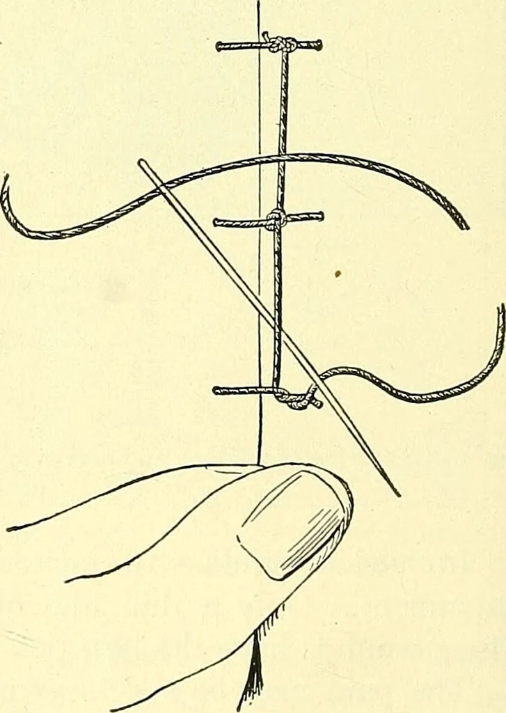 An illustration from Modern surgery, general and operative / by John Chalmers Da Costa., 1907, leaf 254