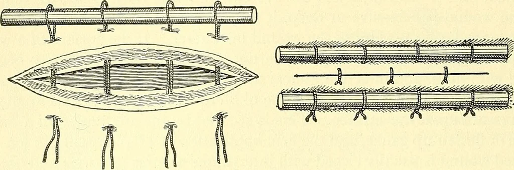 An illustration from Modern surgery, general and operative / by John Chalmers Da Costa., 1907, leaf 256