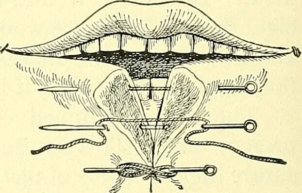 An illustration from Modern surgery, general and operative / by John Chalmers Da Costa., 1907, leaf 256