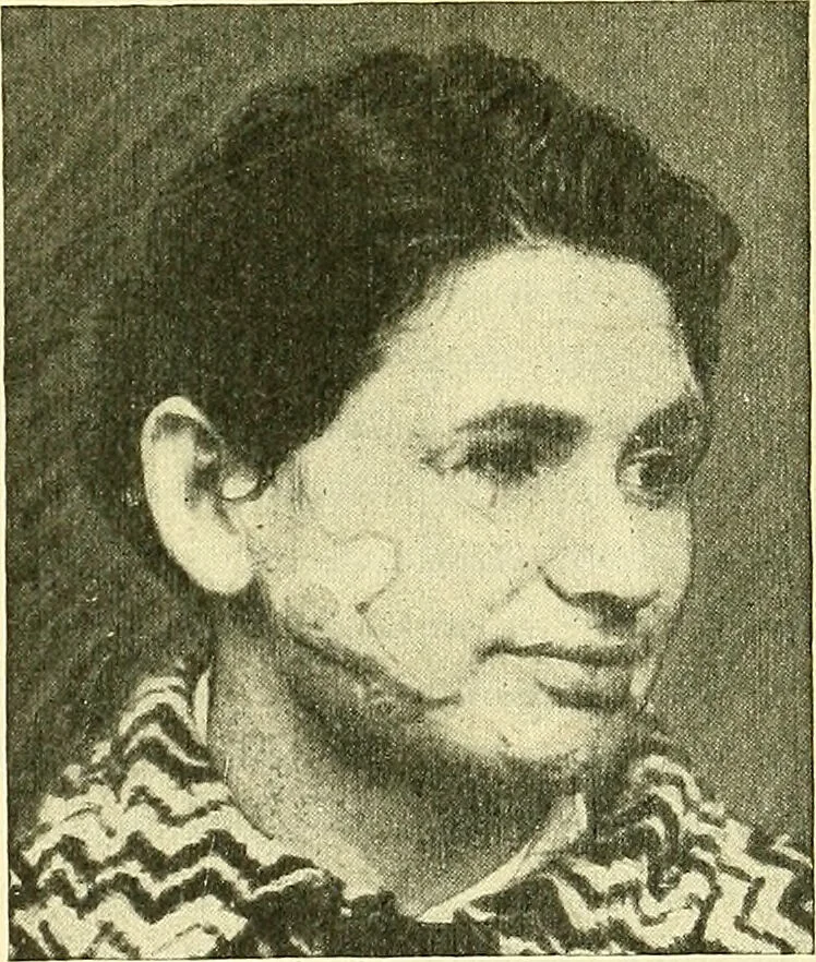 An illustration from Modern surgery, general and operative / by John Chalmers Da Costa., 1907, leaf 311
