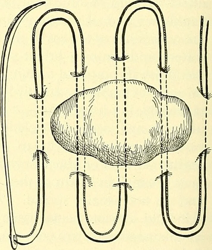 An illustration from Modern surgery, general and operative / by John Chalmers Da Costa., 1907, leaf 320