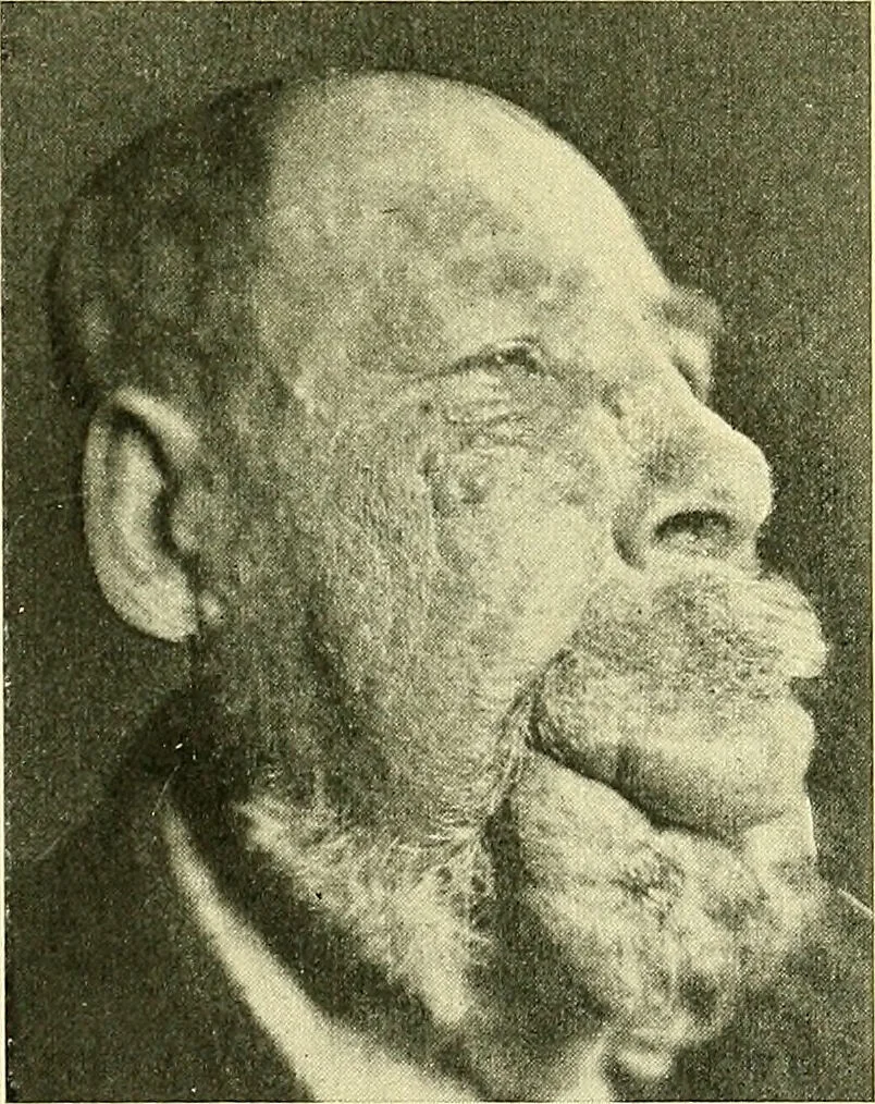 An illustration from Modern surgery, general and operative / by John Chalmers Da Costa., 1907, leaf 321