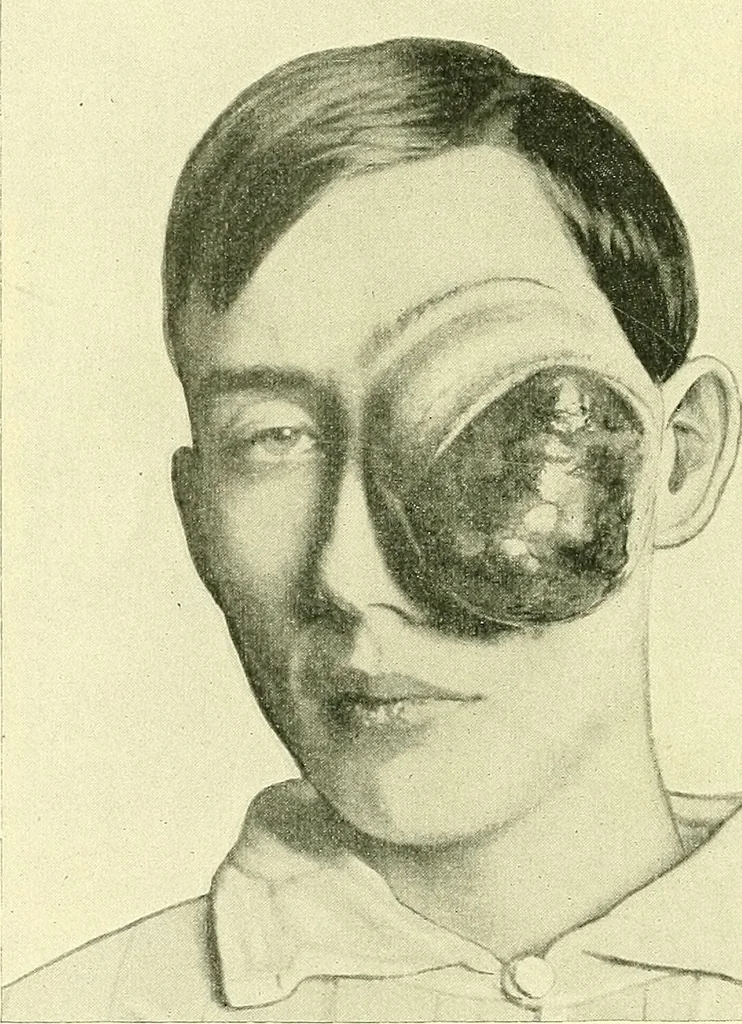 An illustration from Modern surgery, general and operative / by John Chalmers Da Costa., 1907, leaf 328