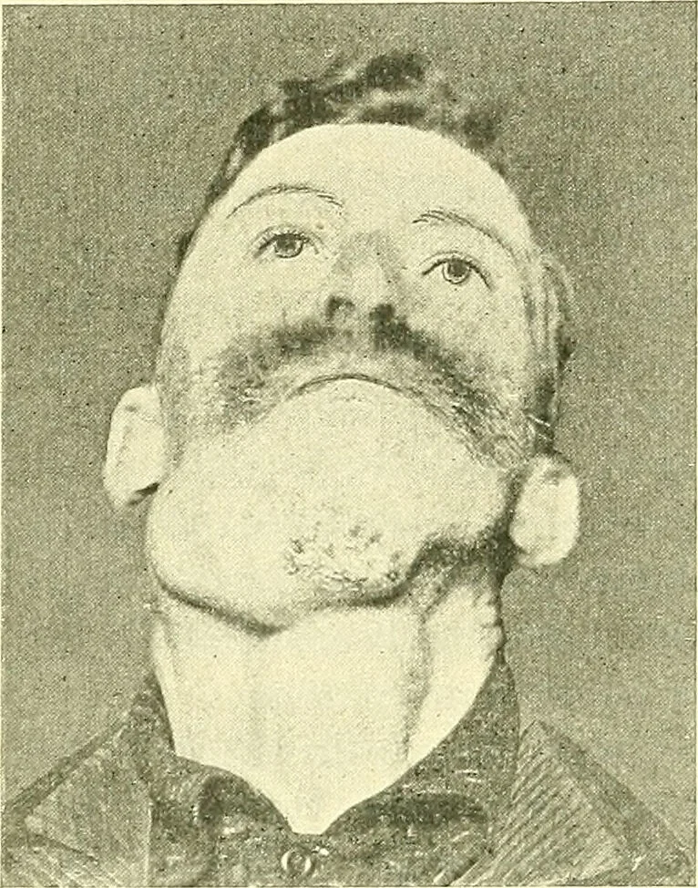 An illustration from Modern surgery, general and operative / by John Chalmers Da Costa., 1907, leaf 336
