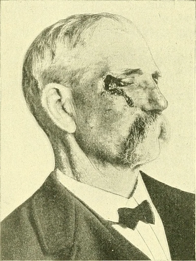An illustration from Modern surgery, general and operative / by John Chalmers Da Costa., 1907, leaf 340