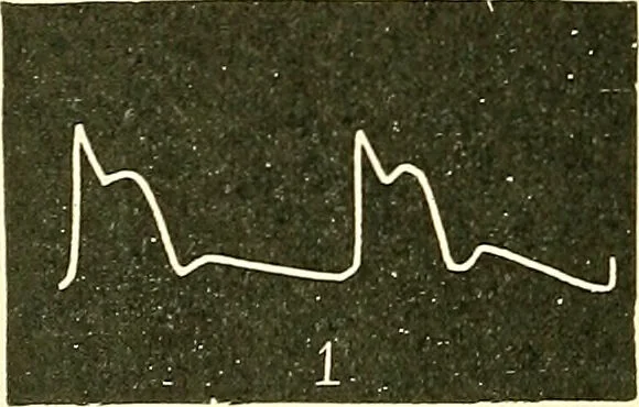 An illustration from Modern surgery, general and operative / by John Chalmers Da Costa., 1907, leaf 366