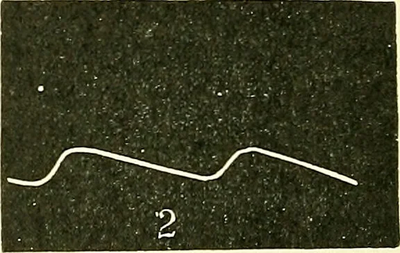An illustration from Modern surgery, general and operative / by John Chalmers Da Costa., 1907, leaf 366