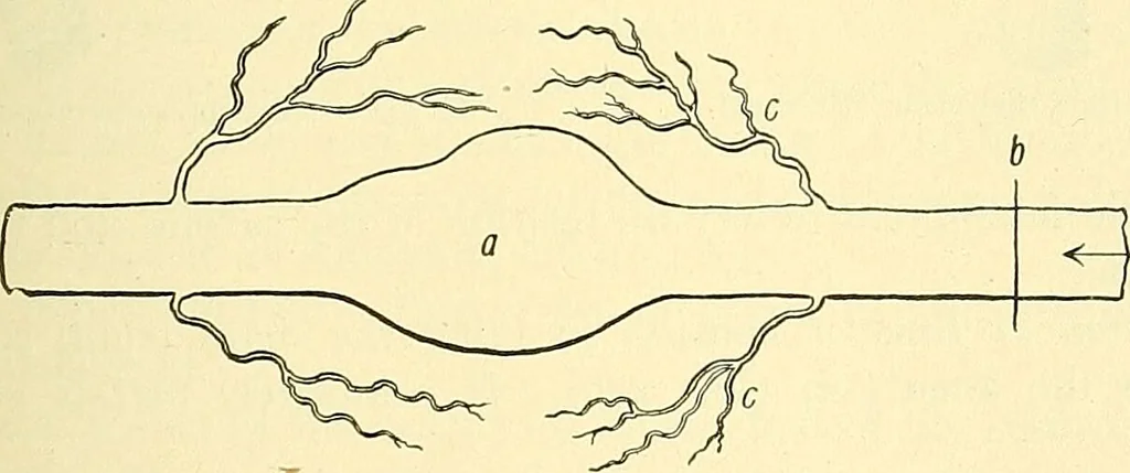 An illustration from Modern surgery, general and operative / by John Chalmers Da Costa., 1907, leaf 371