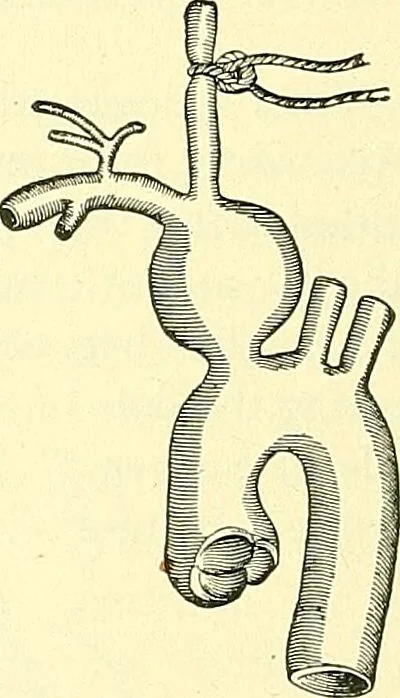 An illustration from Modern surgery, general and operative / by John Chalmers Da Costa., 1907, leaf 372