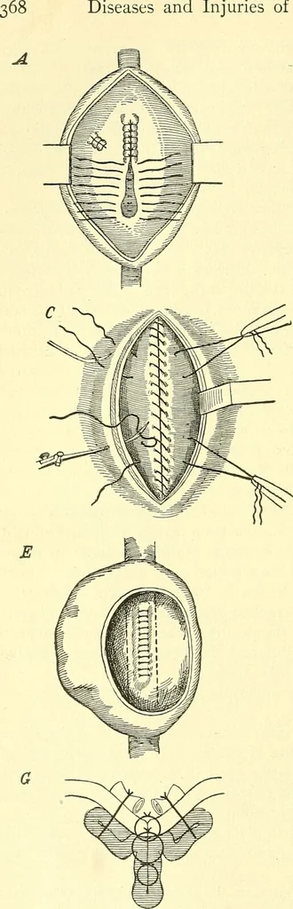 An illustration from Modern surgery, general and operative / by John Chalmers Da Costa., 1907, leaf 374