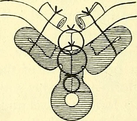 An illustration from Modern surgery, general and operative / by John Chalmers Da Costa., 1907, leaf 374