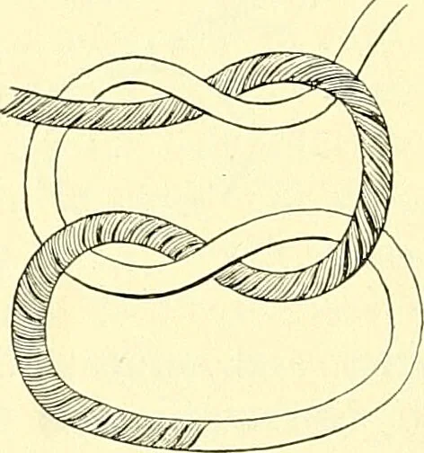 An illustration from Modern surgery, general and operative / by John Chalmers Da Costa., 1907, leaf 384