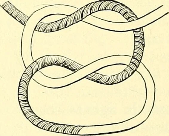An illustration from Modern surgery, general and operative / by John Chalmers Da Costa., 1907, leaf 384